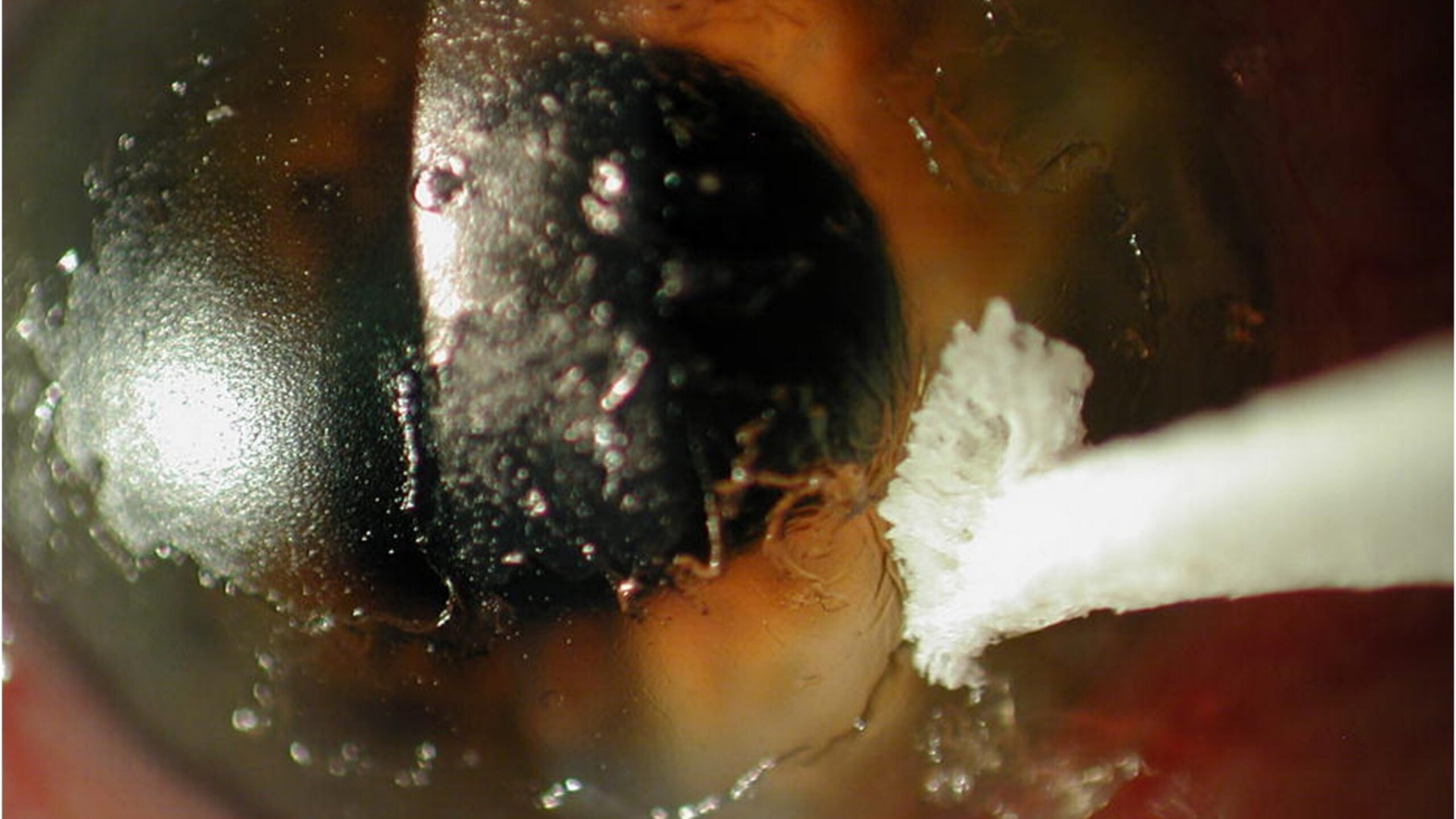 ulcer